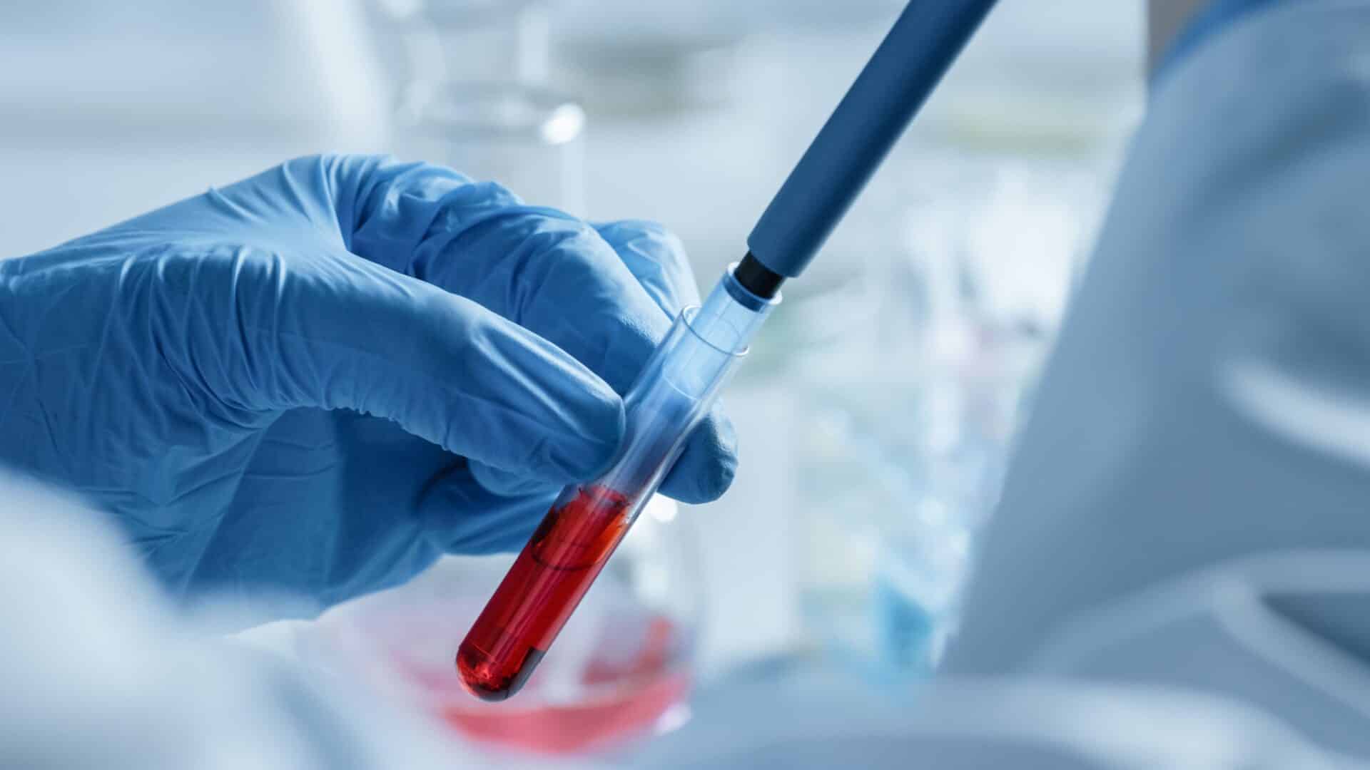 Une simple prise de sang suffit pour diagnostiquer l'hémocromatose